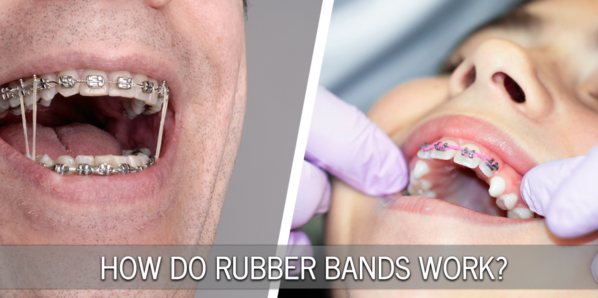 Elastic (Rubber Bands) in Orthodontic Treatment
